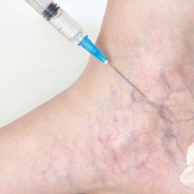 علاج الدوالي