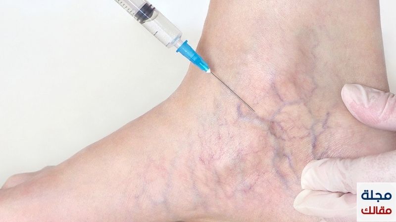 علاج الدوالي